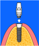 Implantat_Ablauf_Step7